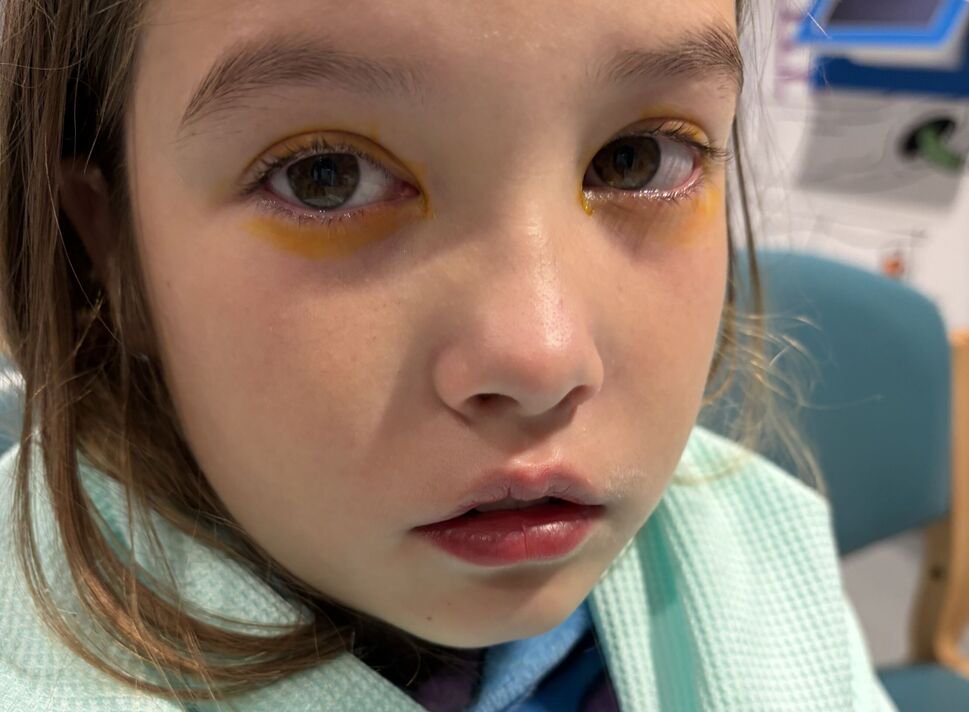 My daughter was almost blinded by this viral ‘beauty hack’