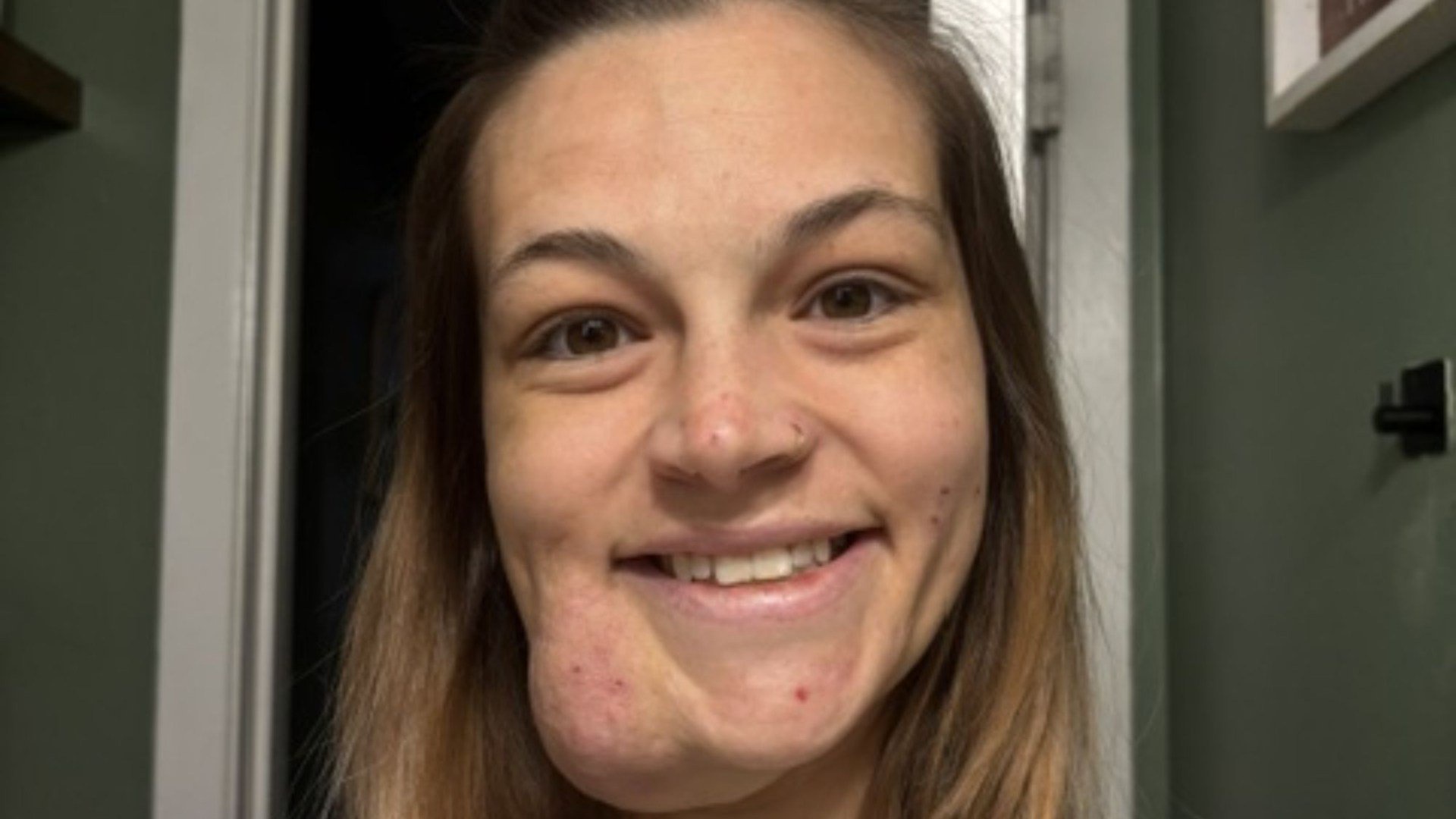 I squeezed a pimple on my face before it grew to a permanent, throbbing growth for 19 years – trolls call me Quagmire