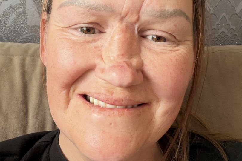‘I jumped into the sea on holiday and lost most of my nose – I looked like a monster’