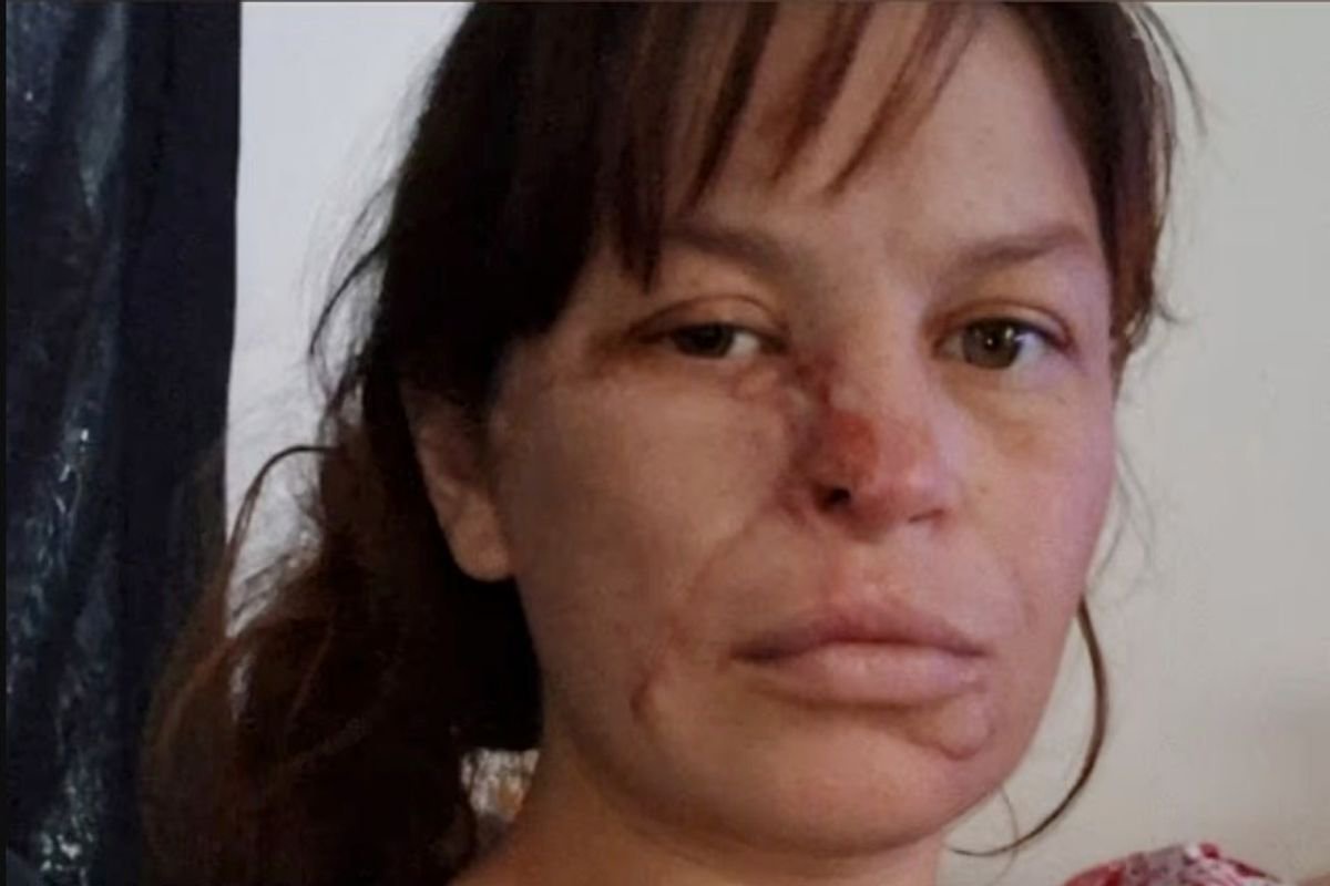 Traumatized woman disfigured by pitbulls while pregnant with twins says she can’t bear the stares
