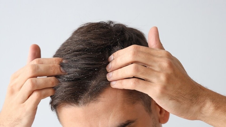Your hair looks clean, but is your scalp healthy? Dermatologist lists 5 warning signs