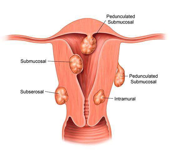 Every Woman Should Avoid Womb Damage By Staying Away From These 3 Things