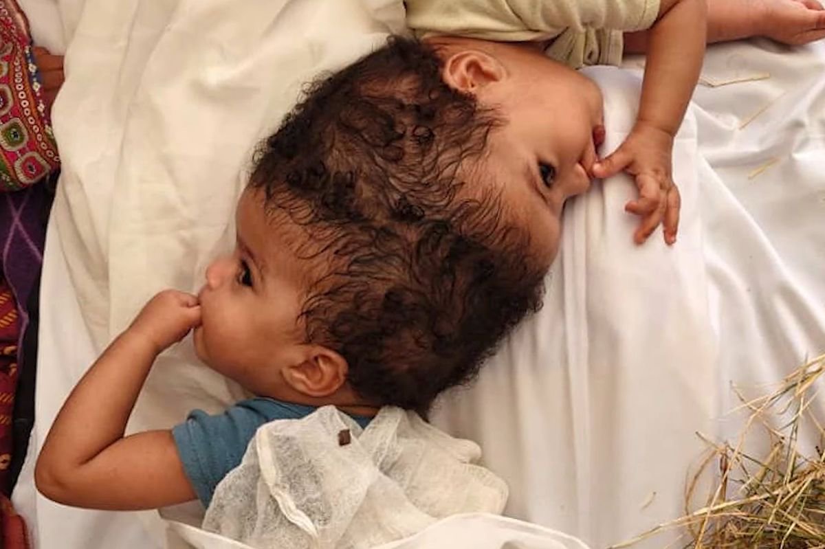 Conjoined twins given new chance at life after extraordinary 24-hour separation surgery