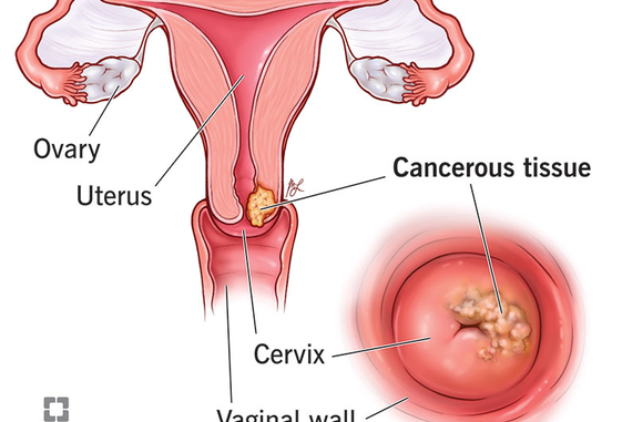 7 Early Warning Signs of Cervical Cancer Every Woman Should Know