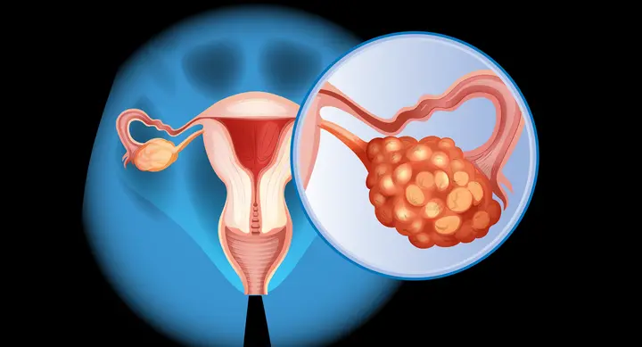 Signs of Ovarian Cancer that Many Overlook