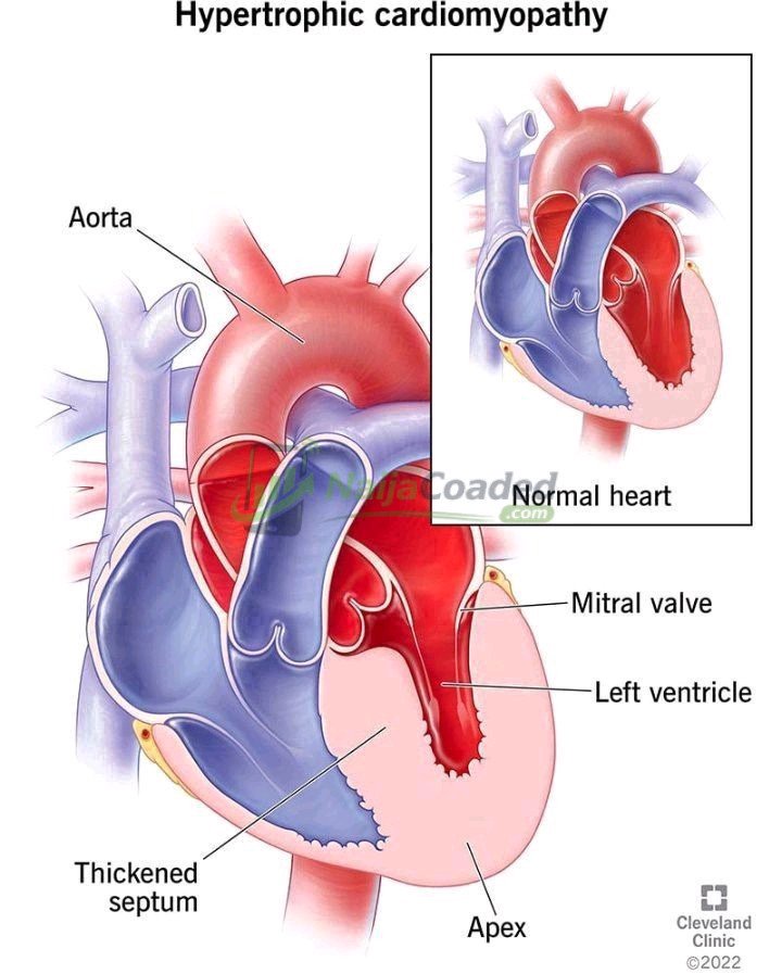 Breaking: Are You Aware That Heart Disease Kill Fast? Avoid Too Much Intake Of These 3 Things If You Want To Live Longer