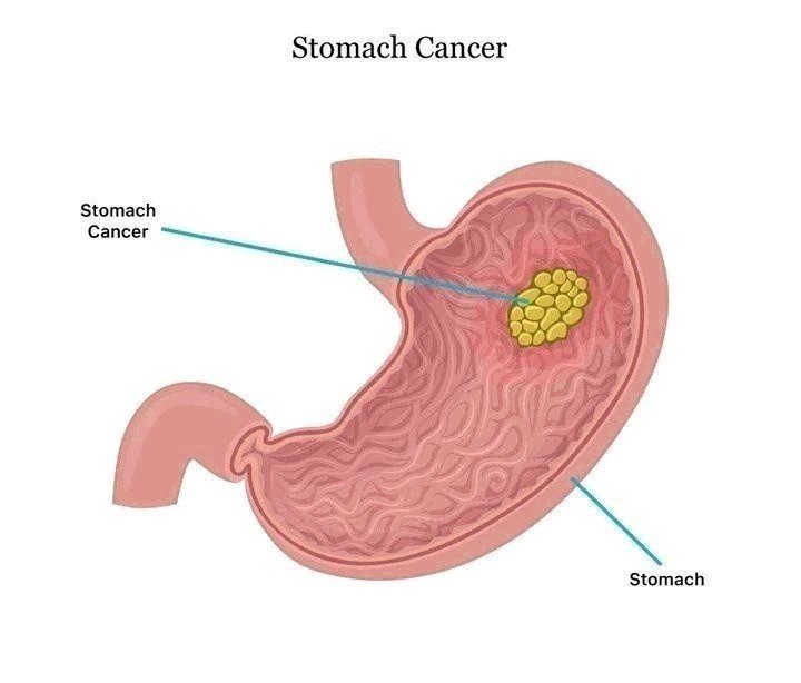 Stomach Cancer: Avoid Too Much Intake of These 5 Things for Better Health