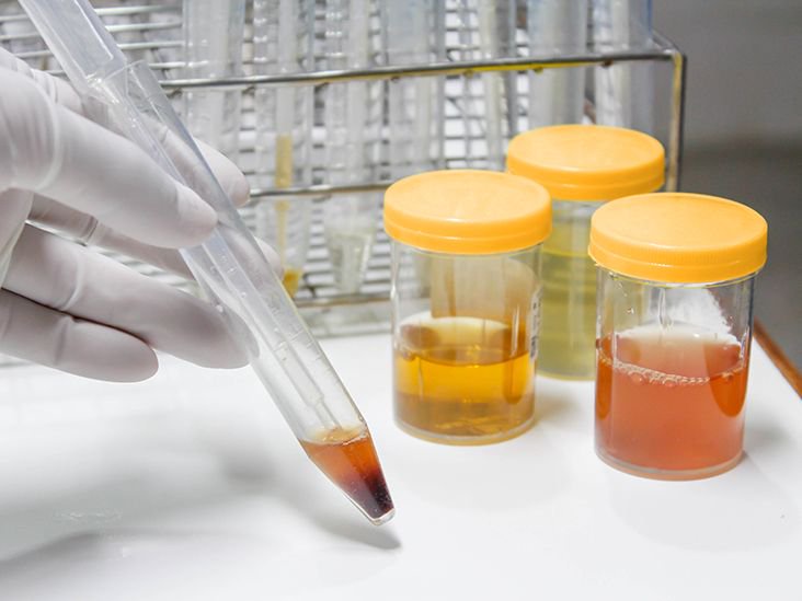 Urine Color and Kidney Health: What Your Pee Reveals About Your Kidneys
