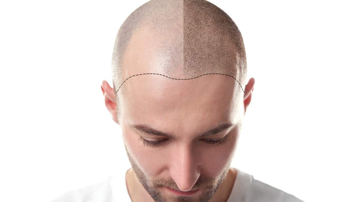Patient Demographics in Hair Transplant Tourism Are Shifting