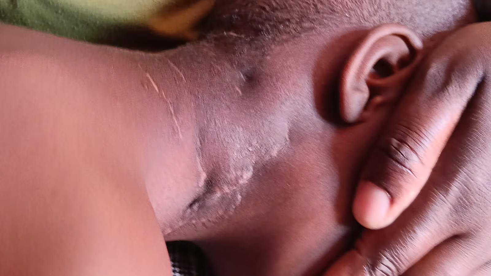 Boy, 6, Survives Horror Pitbull Attack as Mamelodi Mum Thanks God for His Recovery