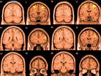 The Effects of Smoking Weed on Your Brain and Mental Health