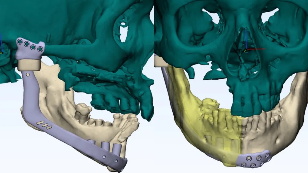 Beat cancer, then lost his jaw: How a 3D model helped rebuild it