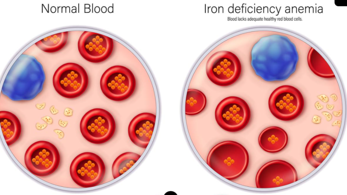 6 Signs That Your Body May Not Be Getting Enough Iron