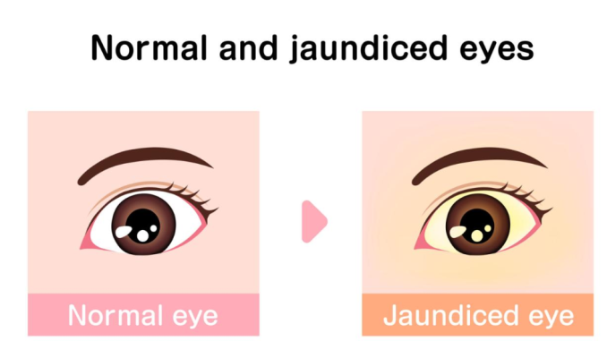 62. If Your Eyes Turn Yellow, Your Liver May Be Showing Signs of a Serious Problem