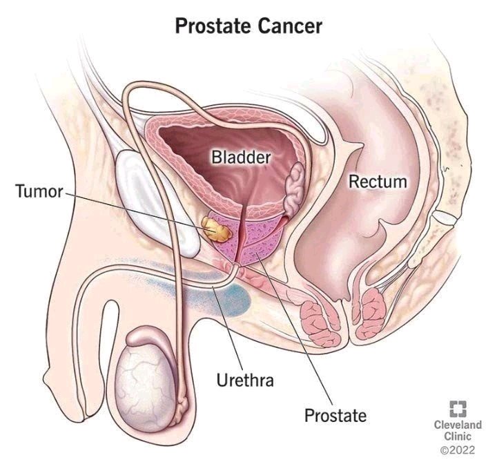 What Men Should Do To Reduce The Risk Of Prostrate Enlargement As They Grow Older