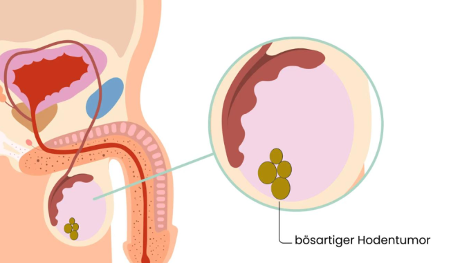 6 Signs of Testicular Cancer Men Should Check For