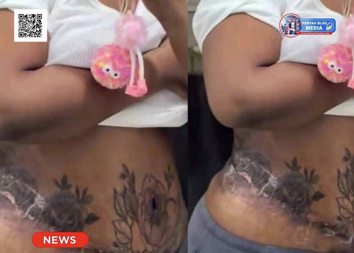 Woman Shares Struggle After Spending GH₵1.5 Billion on Brazilian Butt Lift Surgery