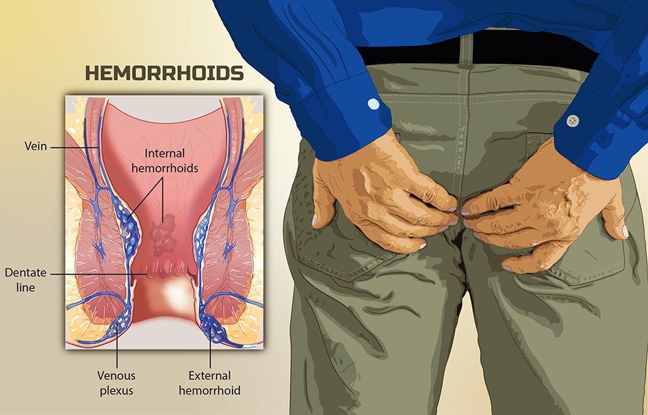 Hemorrhoids: Symptoms, Causes, And Treatment