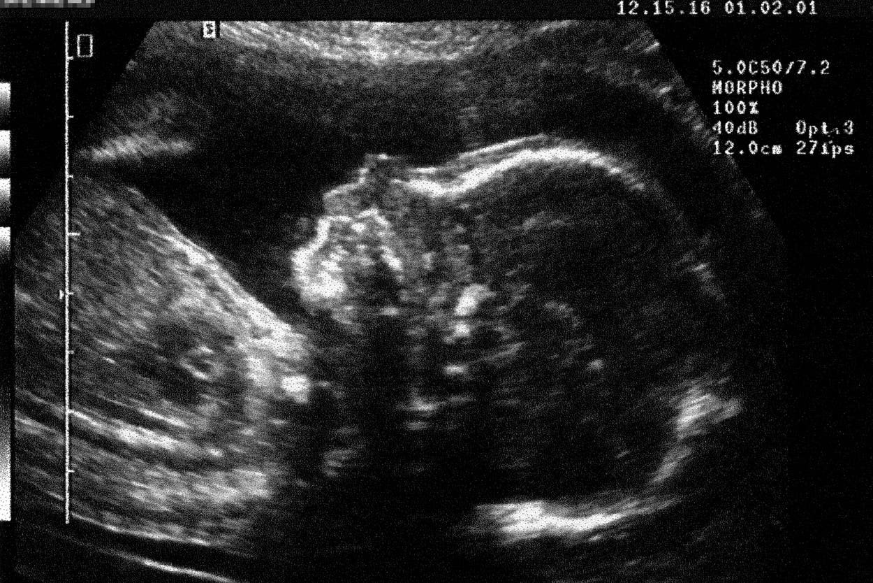 Chinese doctors shrink tumour of baby still in womb in major breakthrough