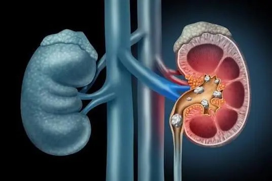 What causes kidney stones? 7 risk factors you should know