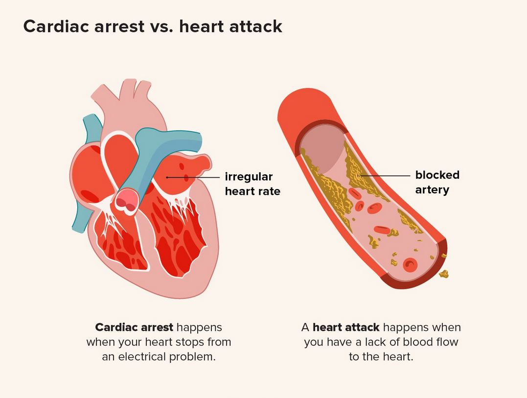 Heart Attack vs Cardiac Arrest: One Mistake Could Be Deadly