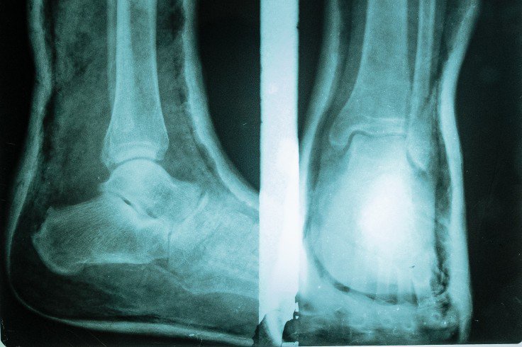 An X-Ray Suggested a Broken Foot but the Player Had Been Carrying That Extra Bone His Whole Life