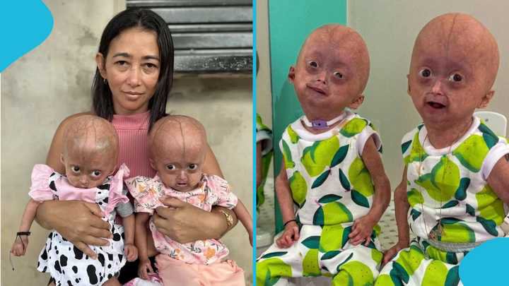 Brazilian Social Media Star Elis Lima Carneiro Dies at 5 After Battle With Rare Ageing Condition
