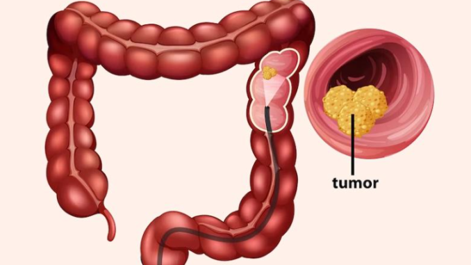 7 Warning Signs of Colon Cancer You Should Not Ignore
