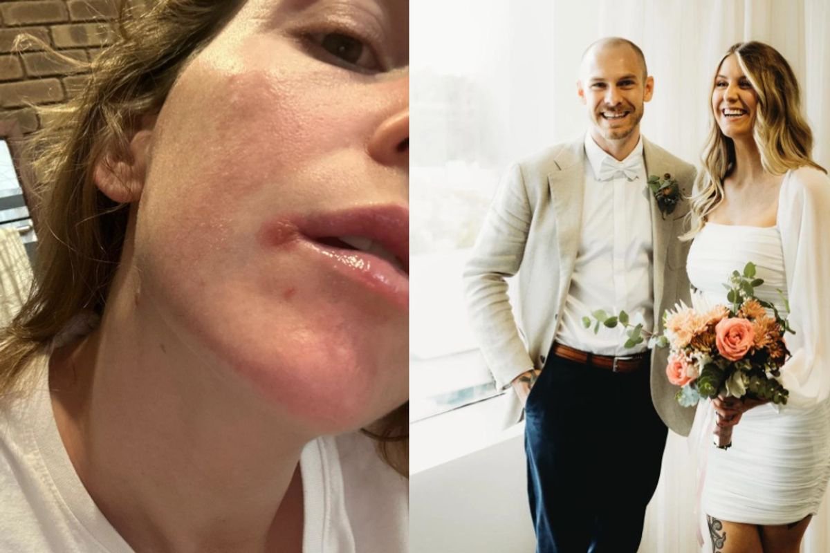 Mum who ‘couldn’t kiss husband at wedding’ finally stops cold sores with £10 balm