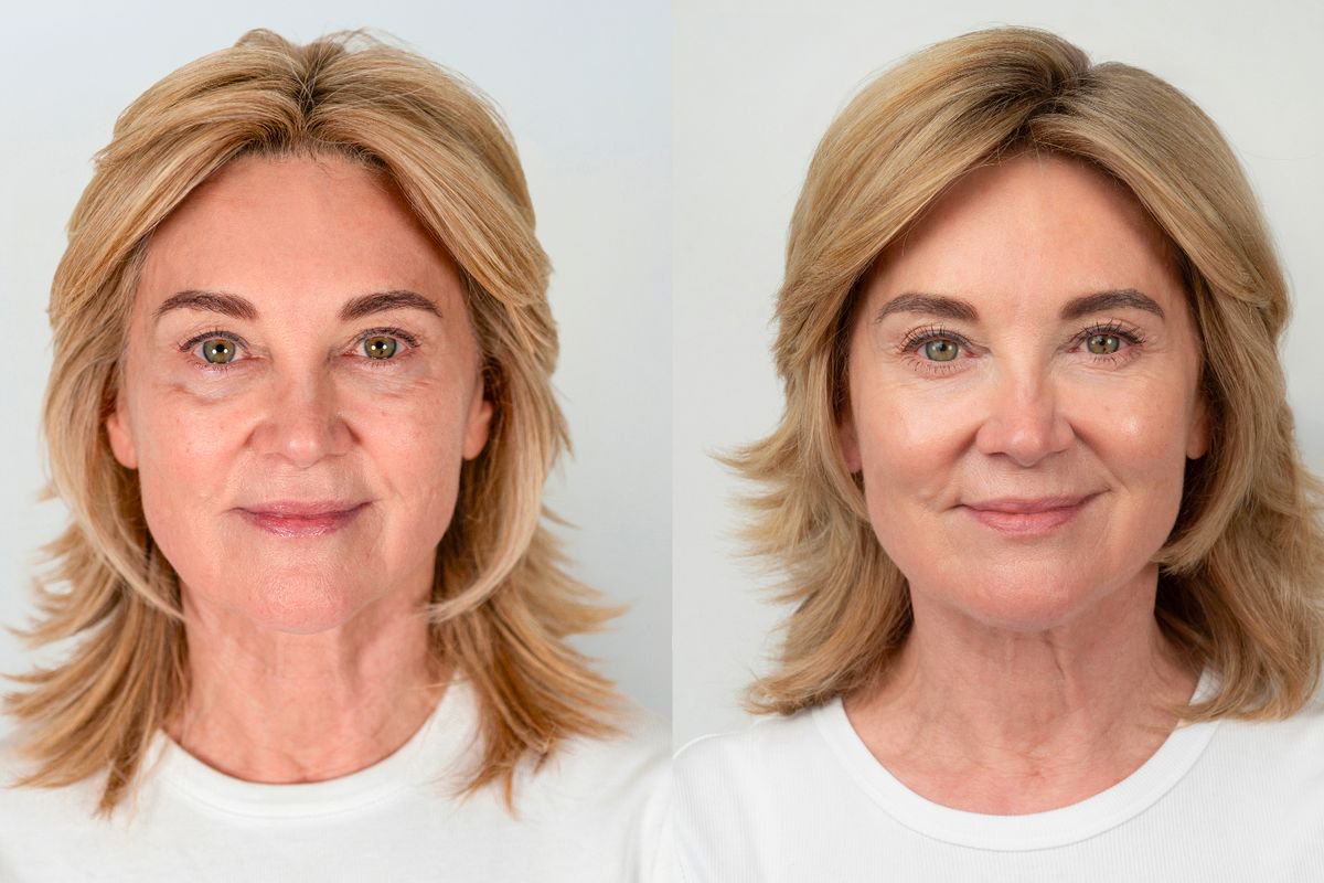 Anthea Turner says she looks 10 years younger after £500 ‘facelift’ treatment