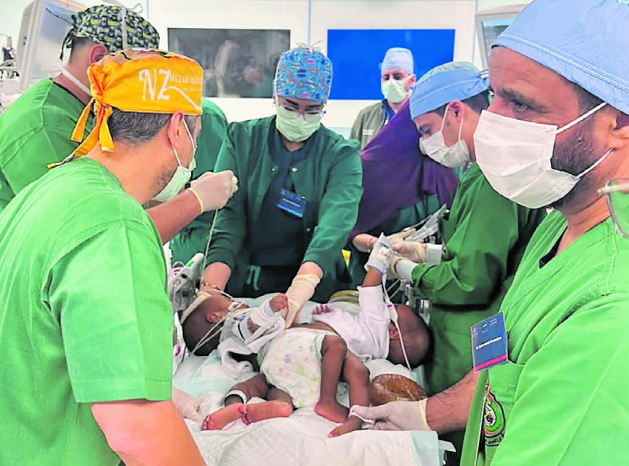 Fijian conjoined twins’ surgery takes 34 professionals over half a day to complete