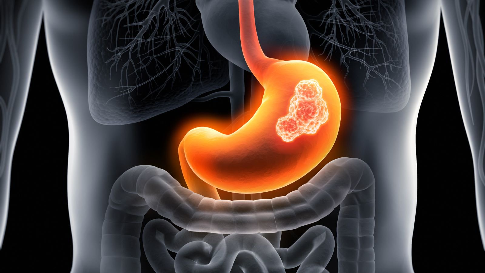 Stomach Cancer Risk: Avoid These 3 Foods to Live Longer