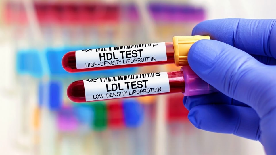 Why is your cholesterol high even though you are slim? A cardiologist explains 6 possible causes beyond weight gain