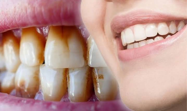 How to get rid of a dark brown stain on your teeth with these simple trick, with photos