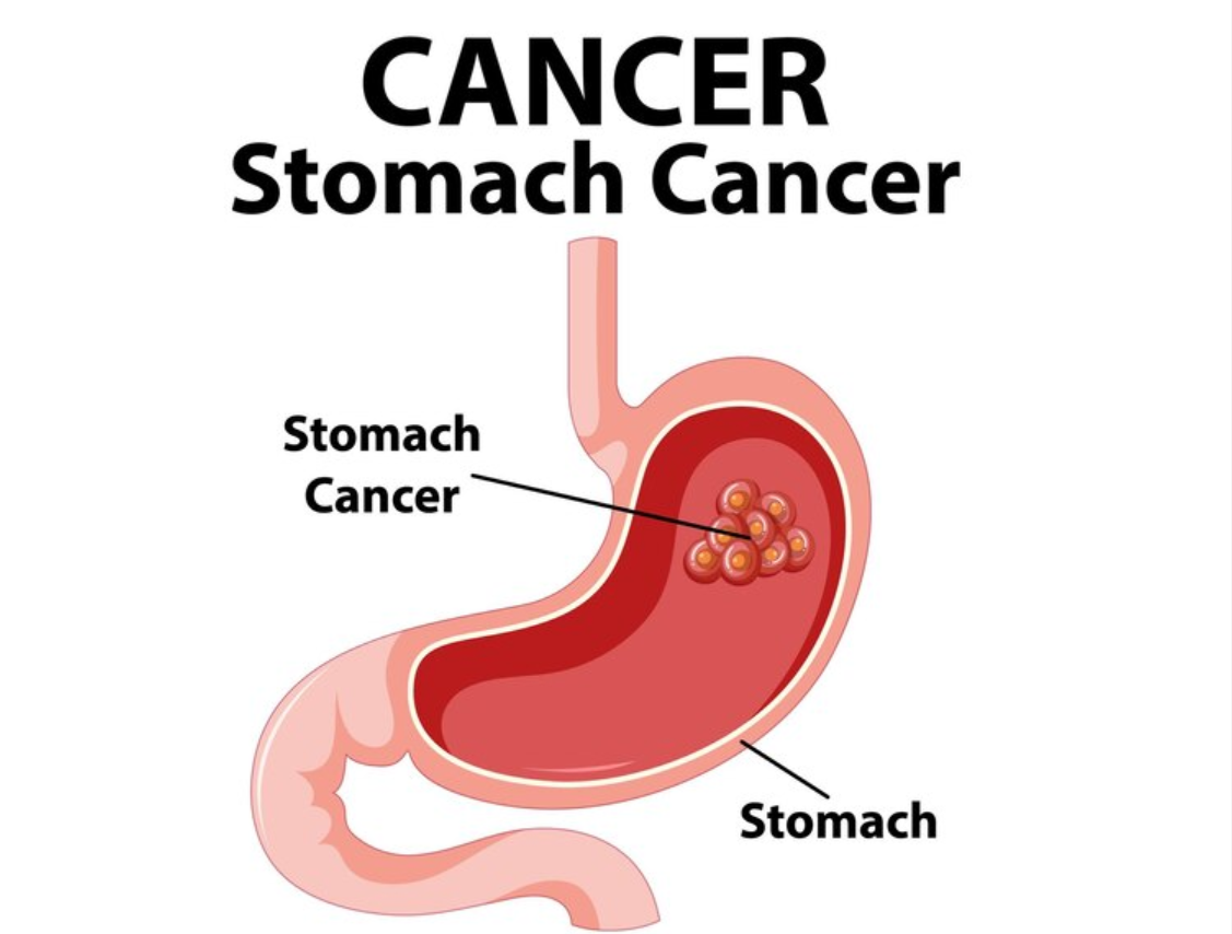 Cancer Of The Stomach Kills, Stop Eating These Three Things If You Want To Live Long