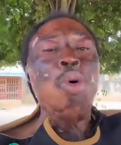 Kwaku Bonsam appeals to Mahama, Ablakwa to facilitate his US travel for skin graft; says he’ll fund it