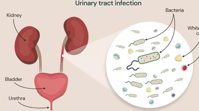 7 Signs of a Urinary Tract Infection (UTI) You Should Take Seriously