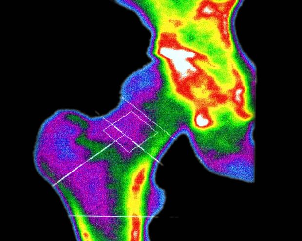 Are your bones brittle? If they were, how would you know? (To men: this goes for you too)