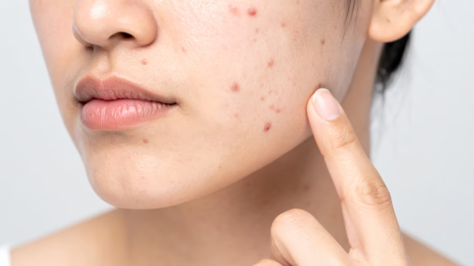 Say Goodbye to Stubborn Pimples: 3 Natural Remedies for Clearer Skin