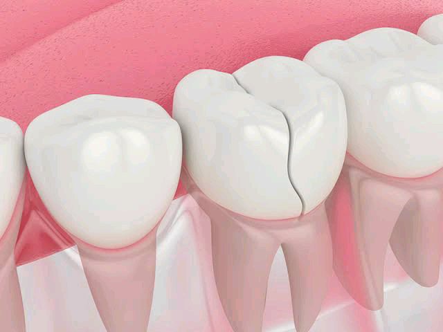 How To Remove Deep Brown Stains From Your Teeth With These Kitchen Ingredients